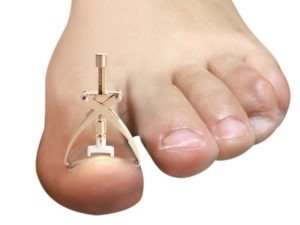 Read more about the article Ingrown Toe Nail Correction Tool